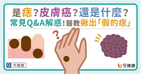 痣的形成原因|是痣？還是皮膚癌？皮膚科醫師教你揪出「假的痣」，。